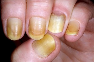 Желтые ногти: почему это происходит и как с этим бороться