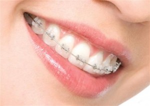 Брекеты – гарант ровных и красивых зубов